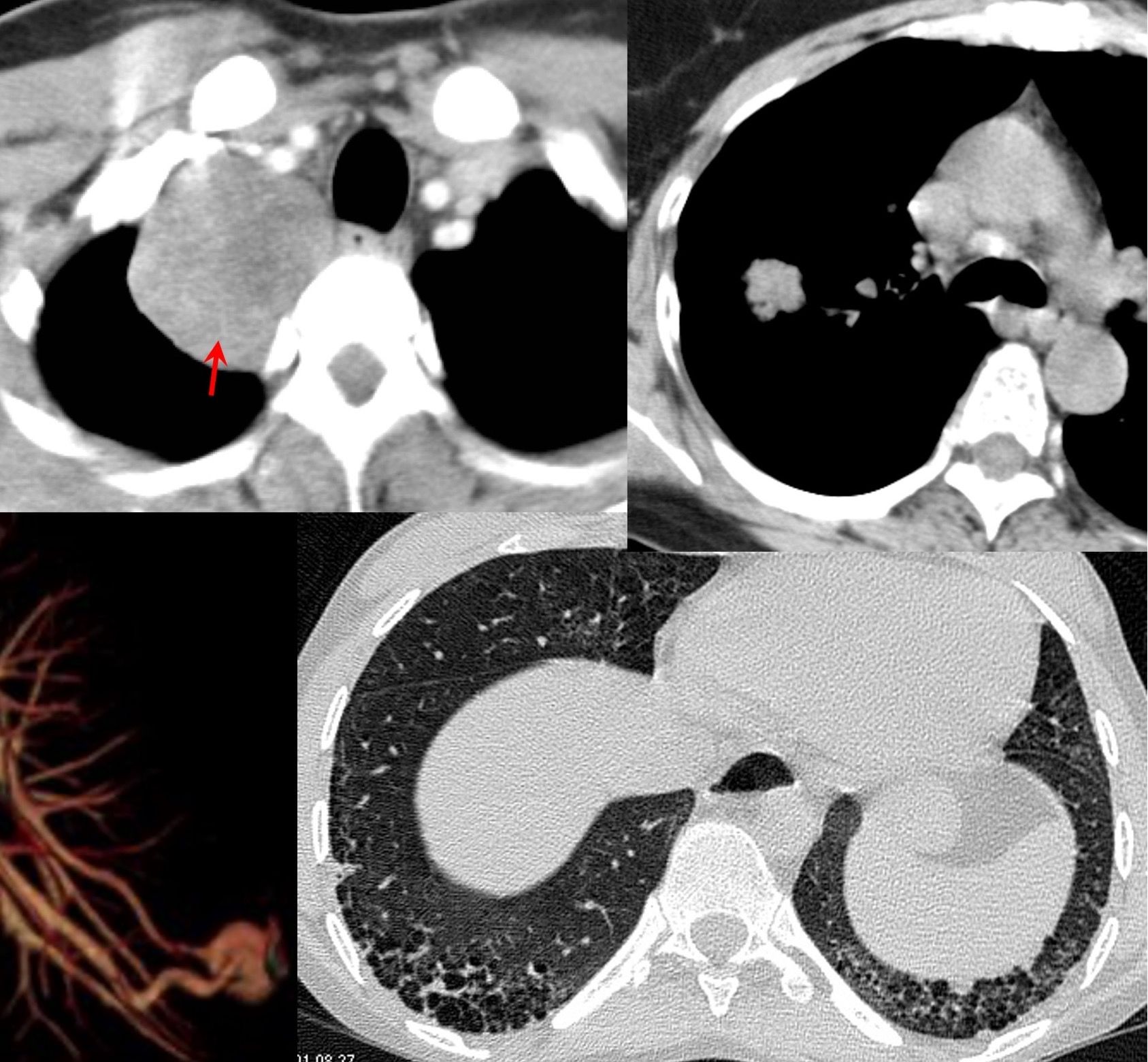 Lecture: Connective Tissue Disease ILDs