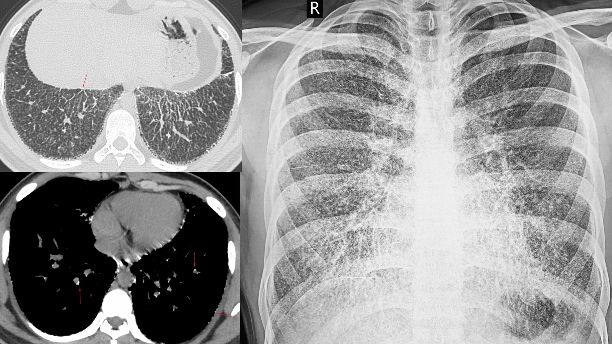 Lungs of Stone Pulmonary Alveolar Microlithiasis Cases and Staging