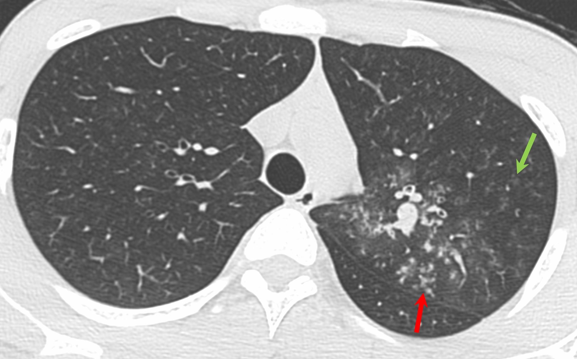 Case 17 tuberculosis and hemoptysis dense and soft centrilobular