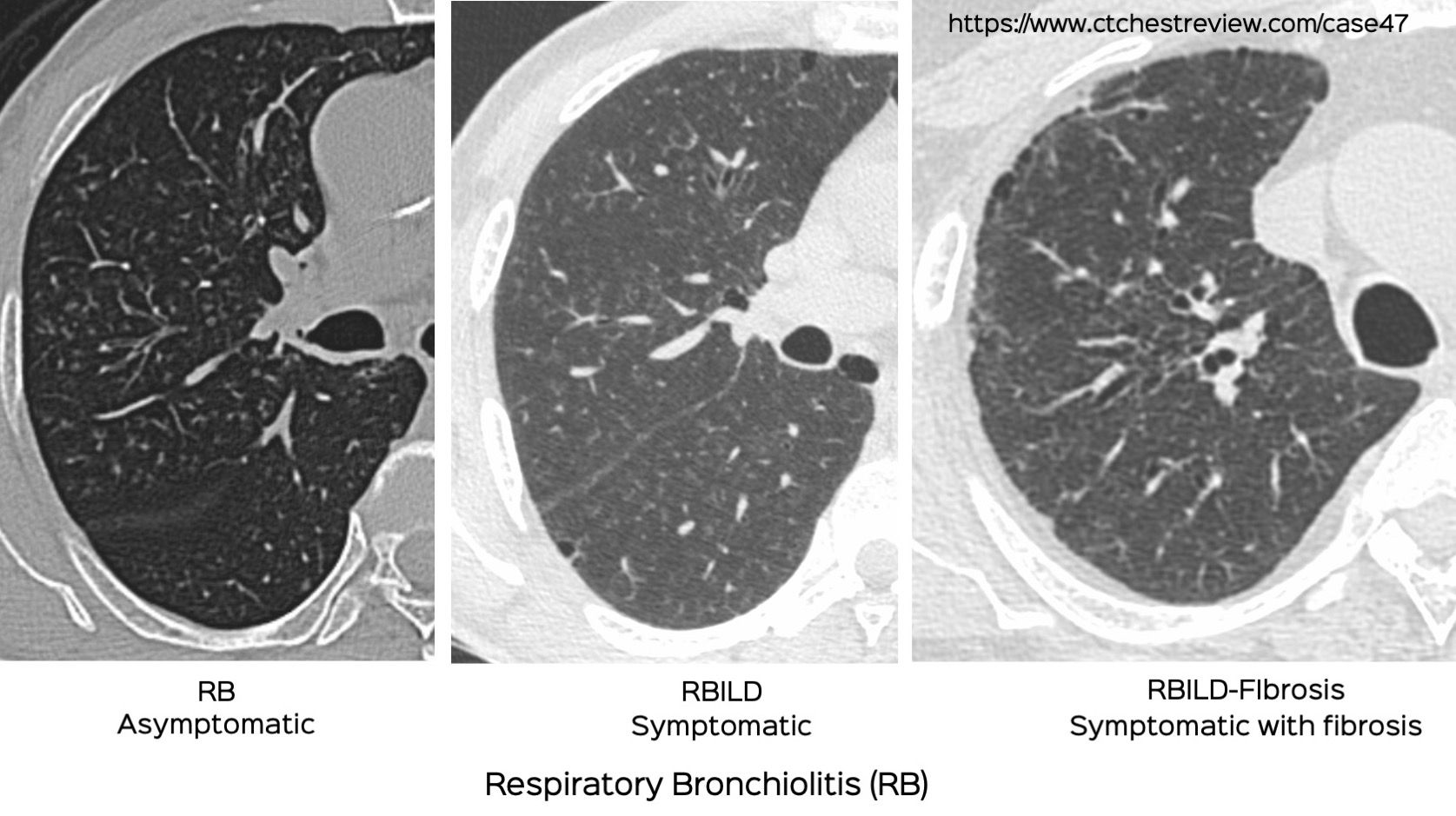 Case 47 When Does RB RBILD and RBILDFibrosis?