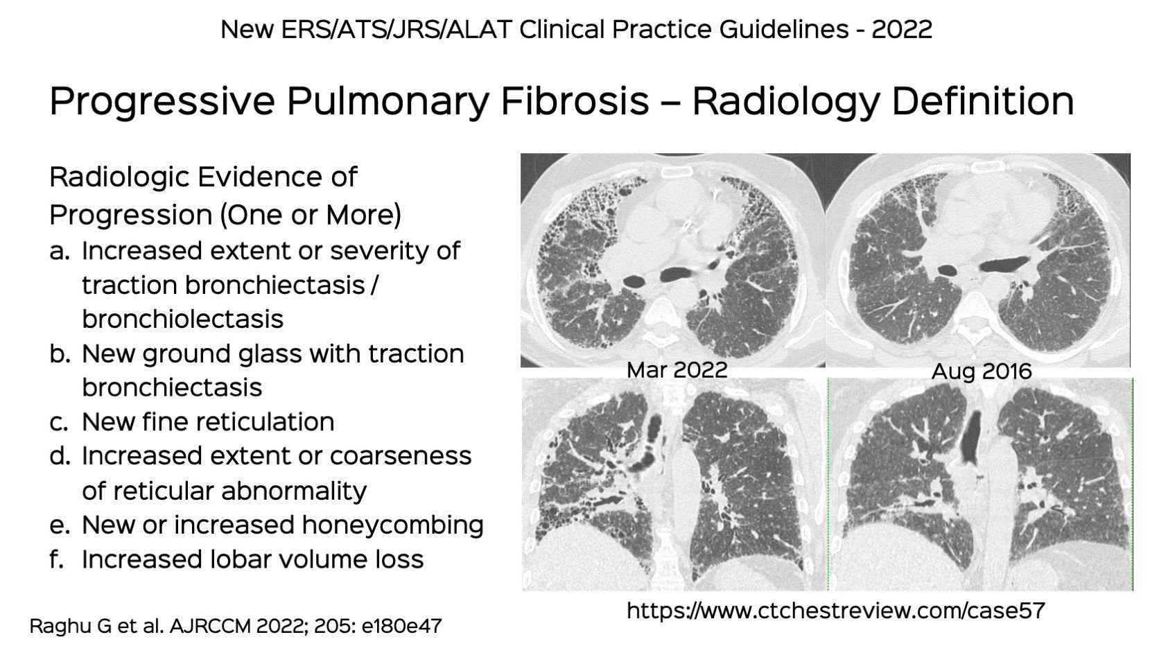 pulmonary fibrosis case presentation ppt