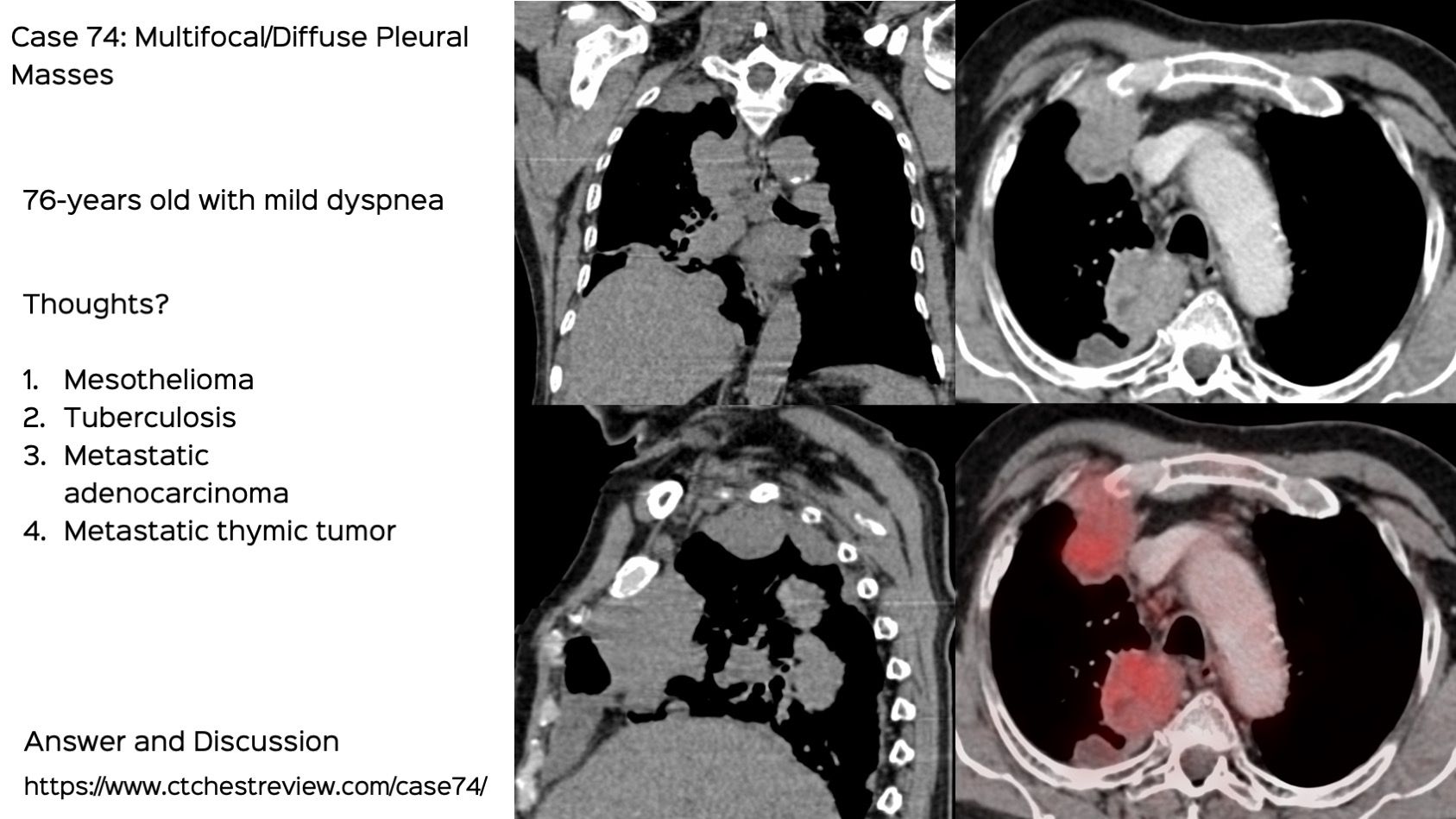 Case 74 Multifocal / Diffuse Pleural Disease