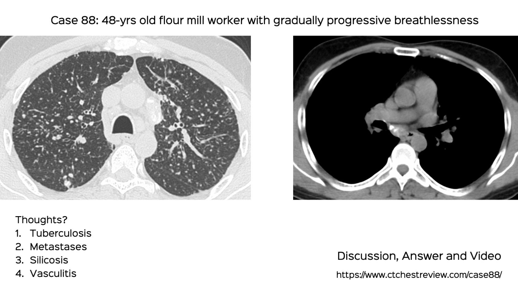 Case 88 Flour Mill Worker Disease