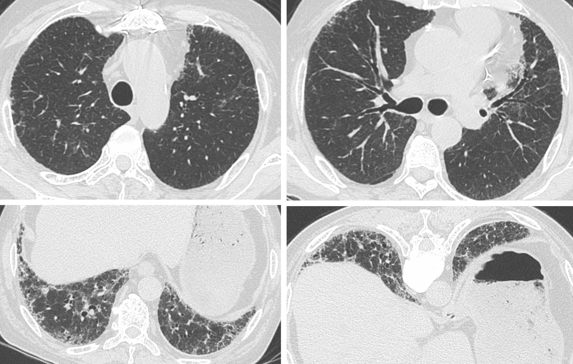 Case 92: New Ground Glass in a Patient with a Fibrosing ILD