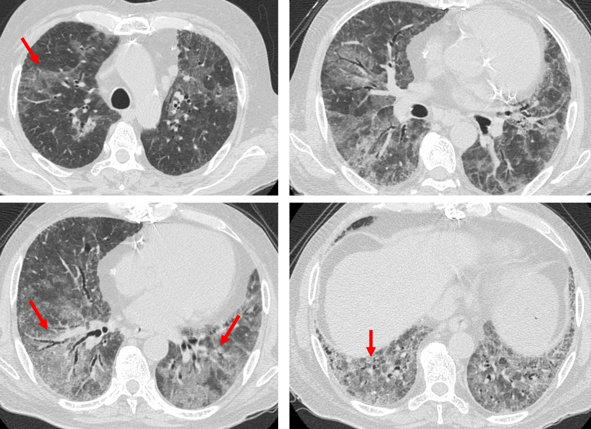 Case 92: New Ground Glass in a Patient with a Fibrosing ILD