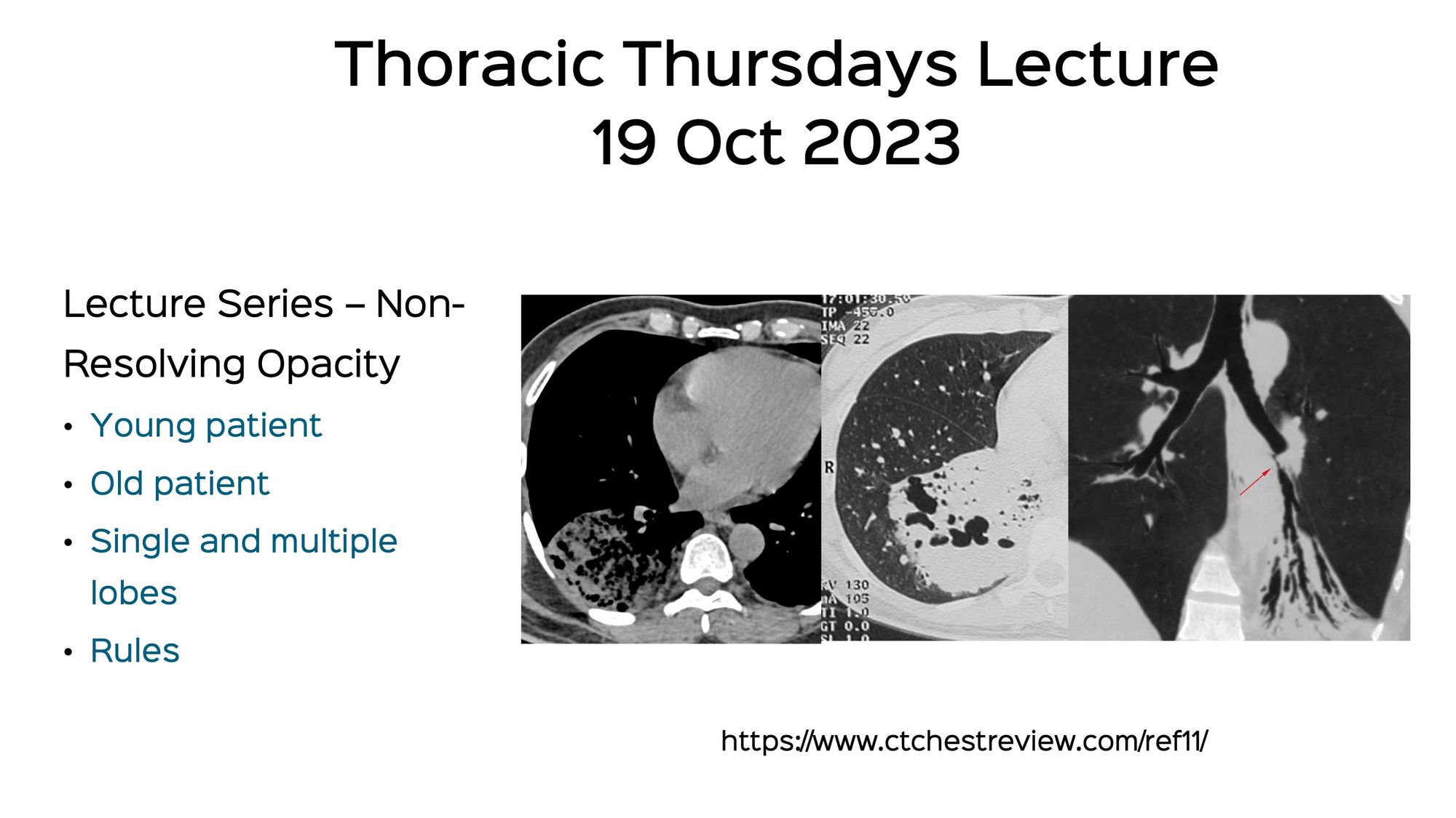 Case 92: New Ground Glass in a Patient with a Fibrosing ILD