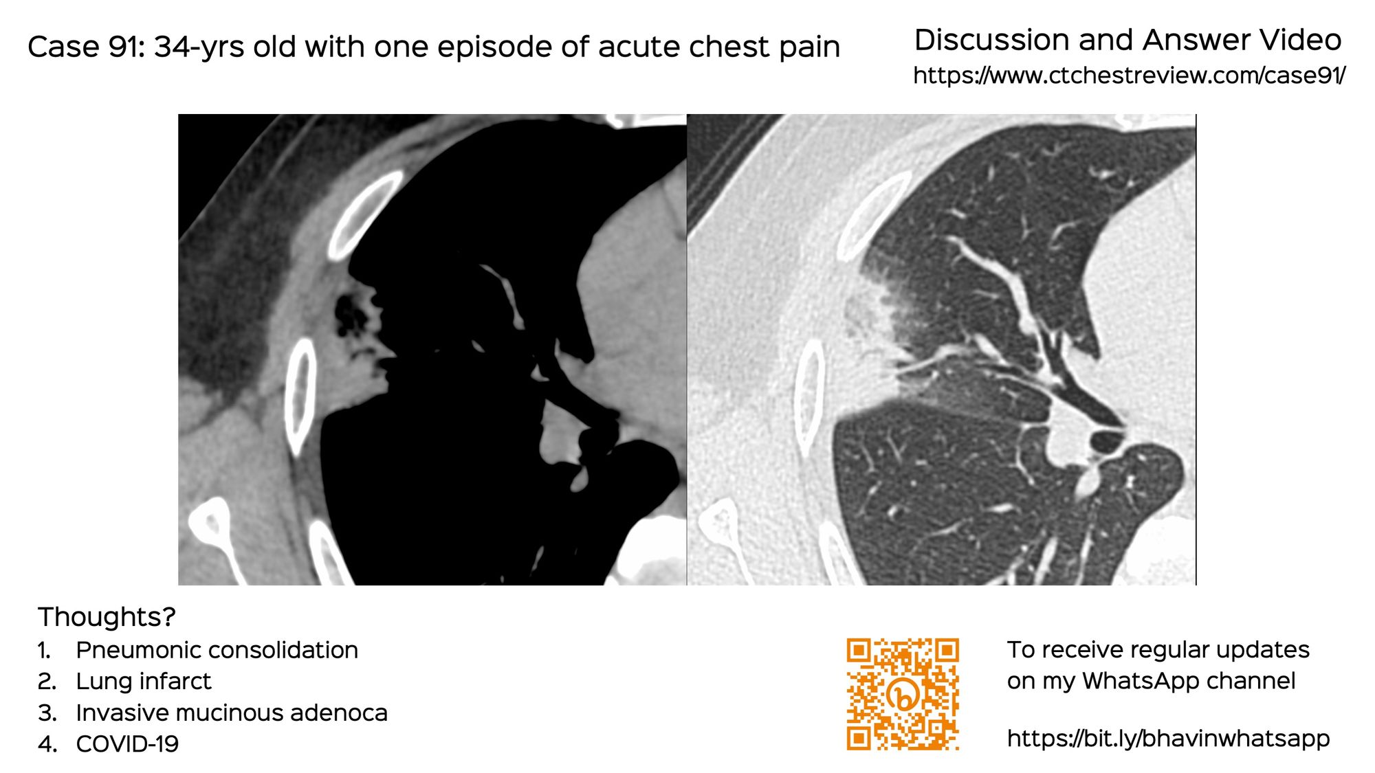 Case 92: New Ground Glass in a Patient with a Fibrosing ILD