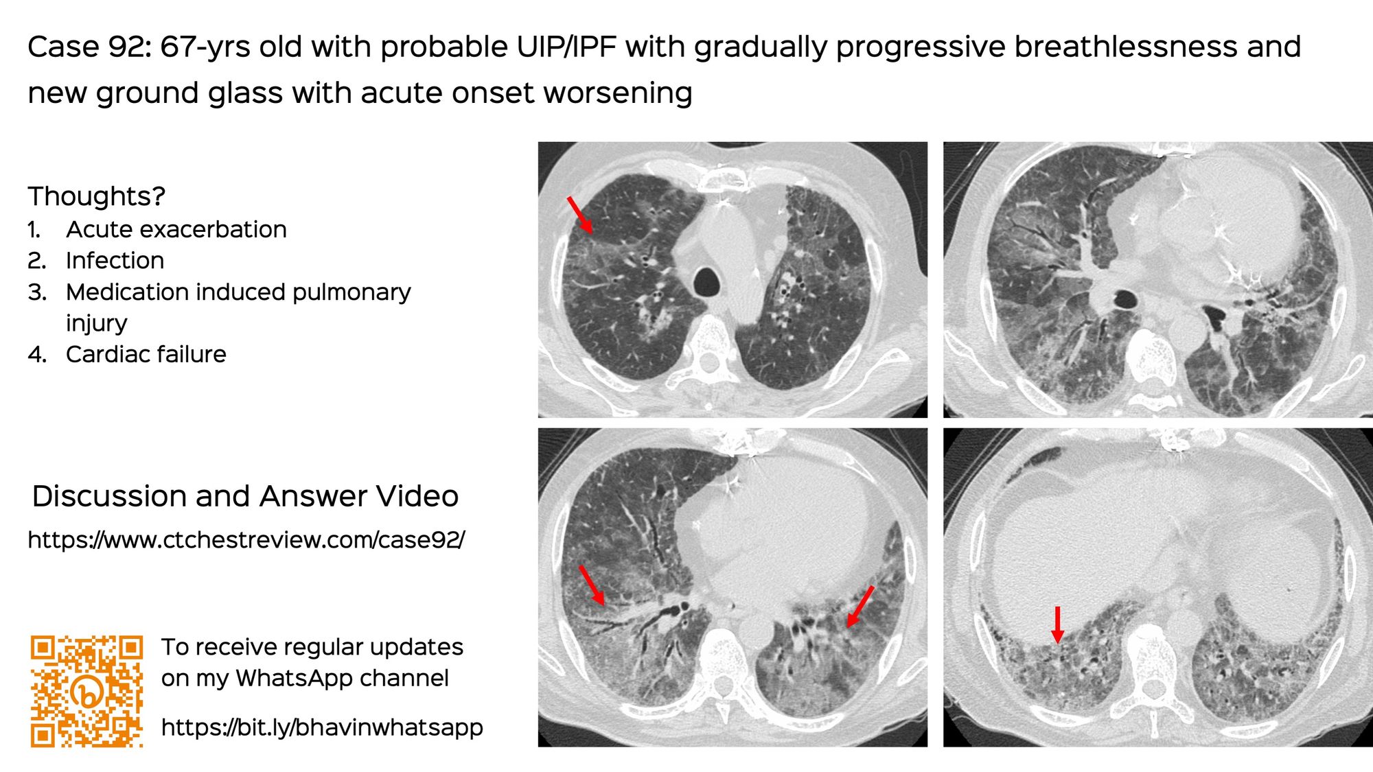 Lecture: Lung Cancer Screening in a TB Endemic Country