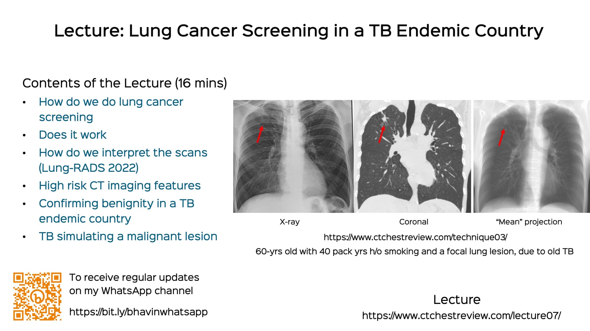 Lecture: Lung Cancer Screening in a TB Endemic Country