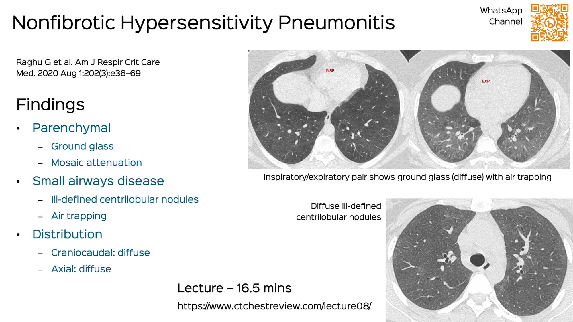 Lecture: CT of Hypersensitivity Pneumonitis
