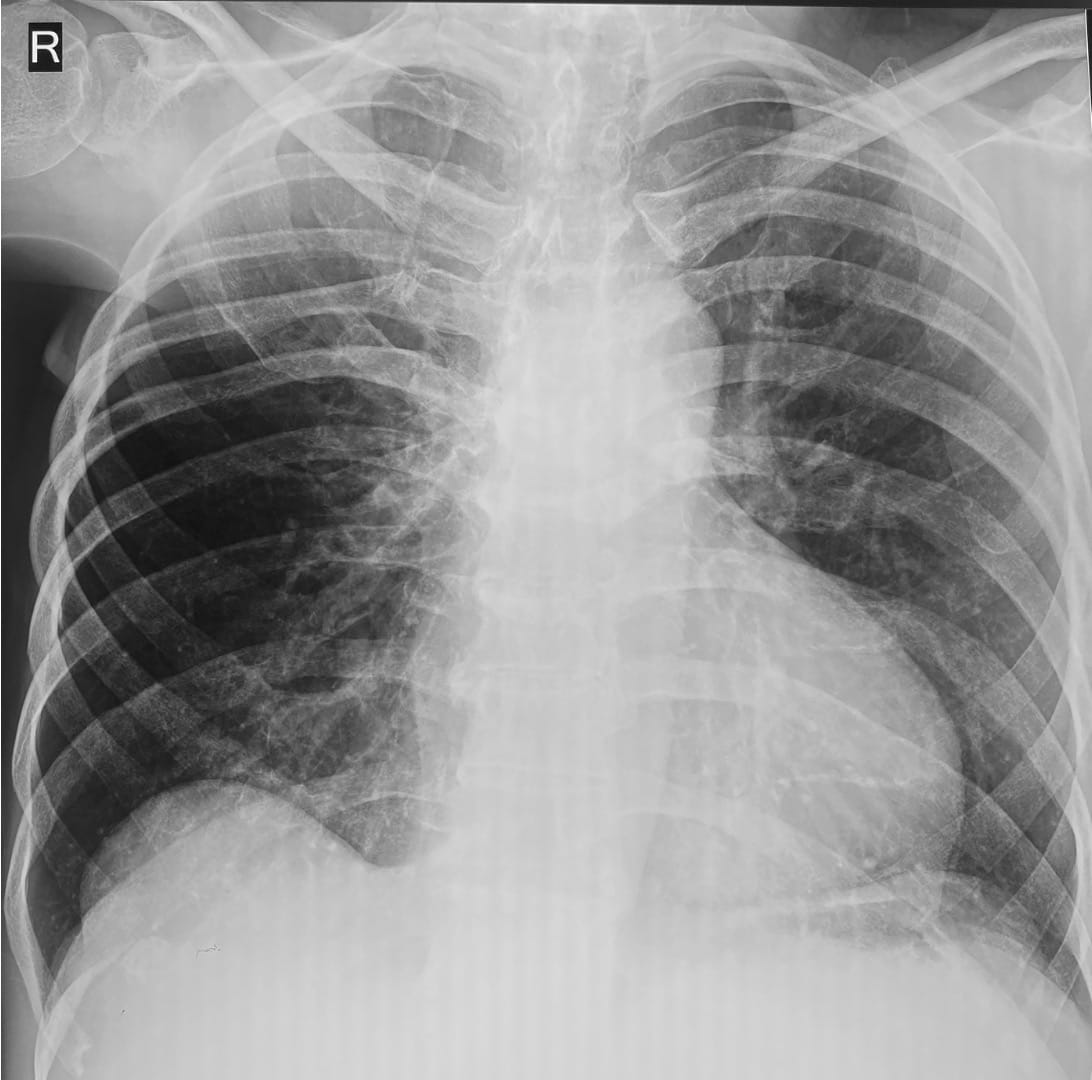 Case 93: The Asymmetric Chest Wall