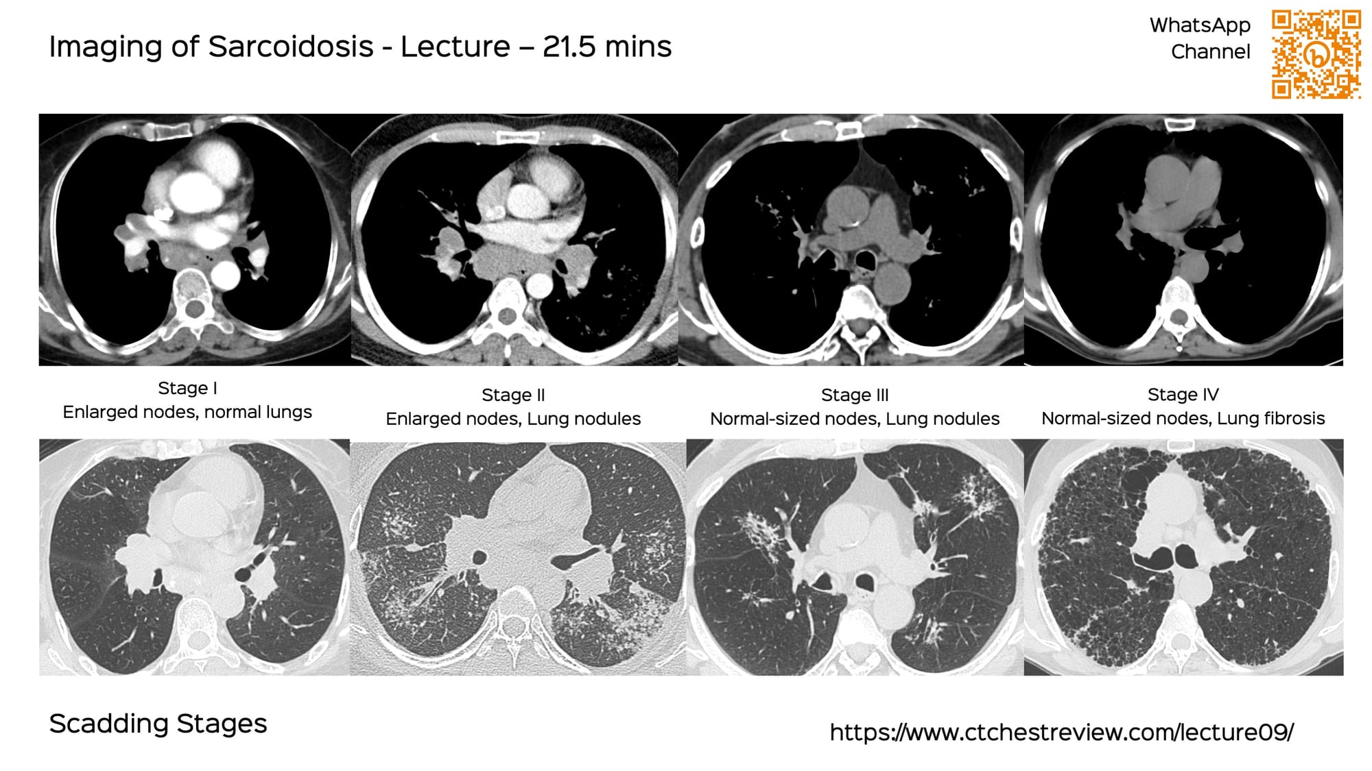 Lecture: Imaging of Sarcoidosis