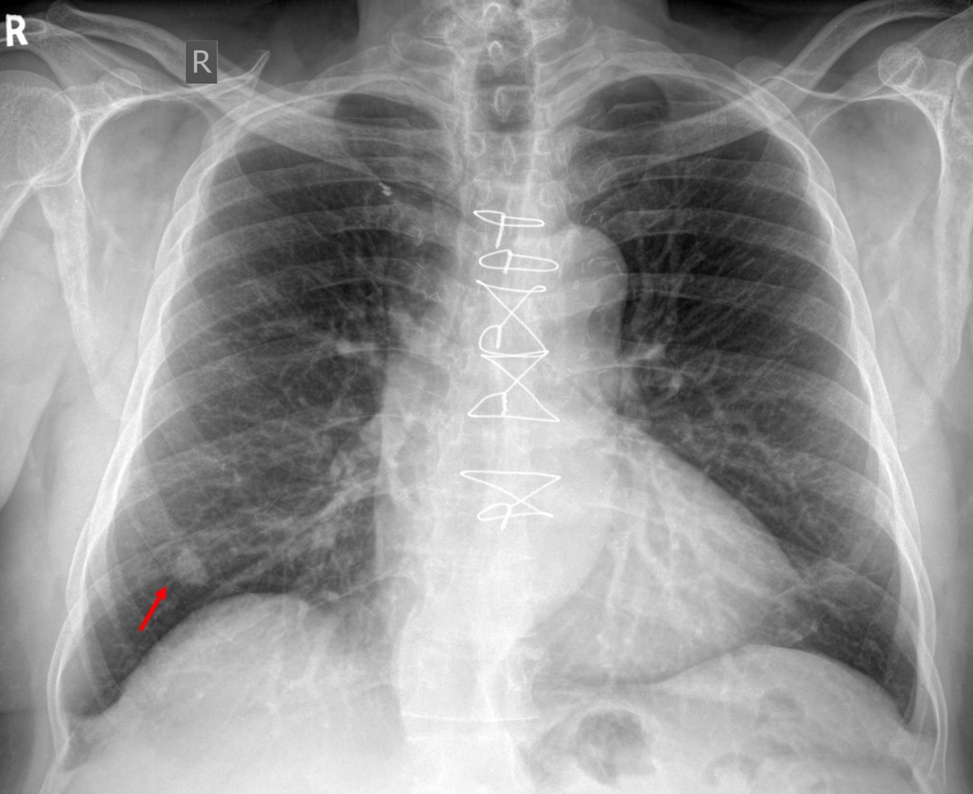 Case 95: When the Nodule is an Island