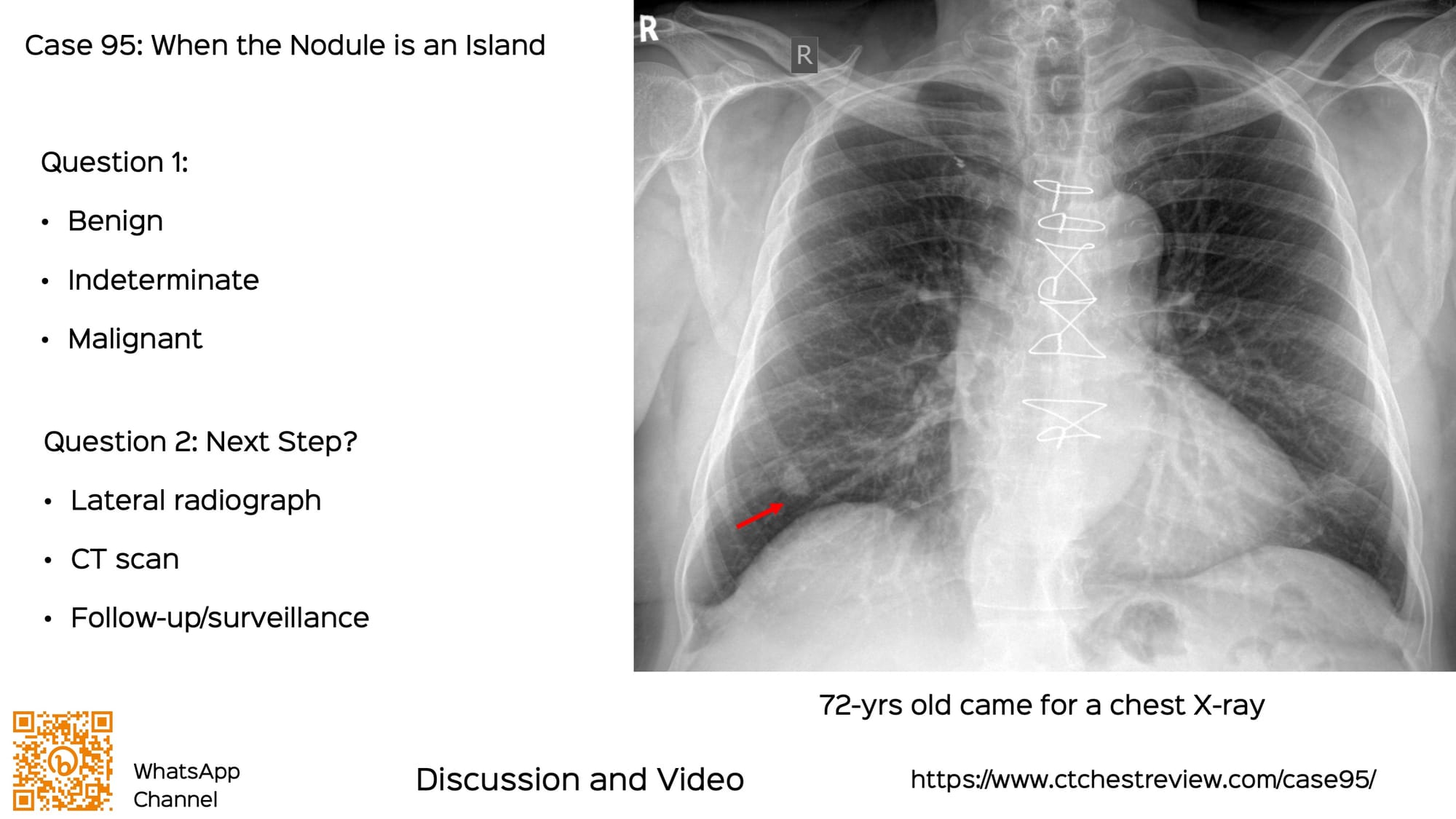 Case 95: When the Nodule is an Island