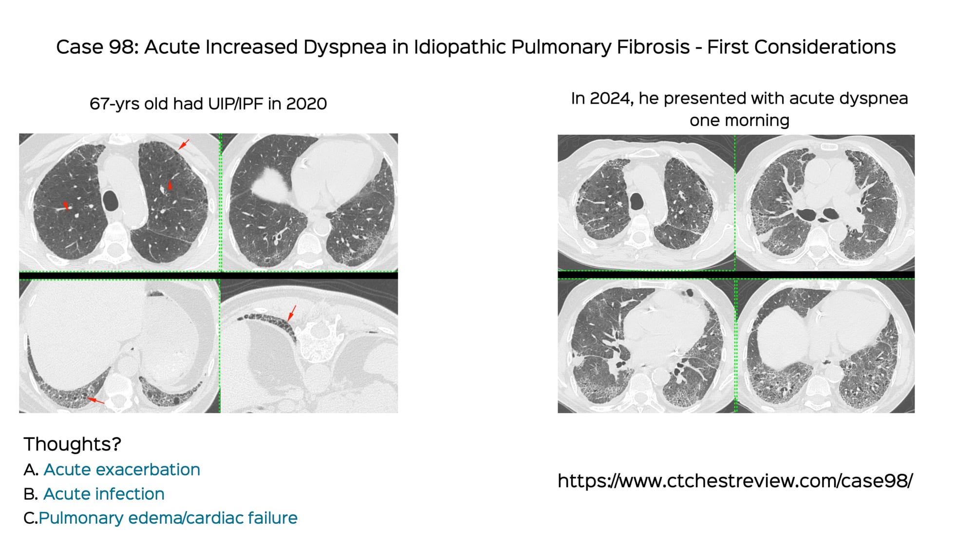 Case 98: Acute Increased Dyspnea in Idiopathic Pulmonary Fibrosis - First Considerations