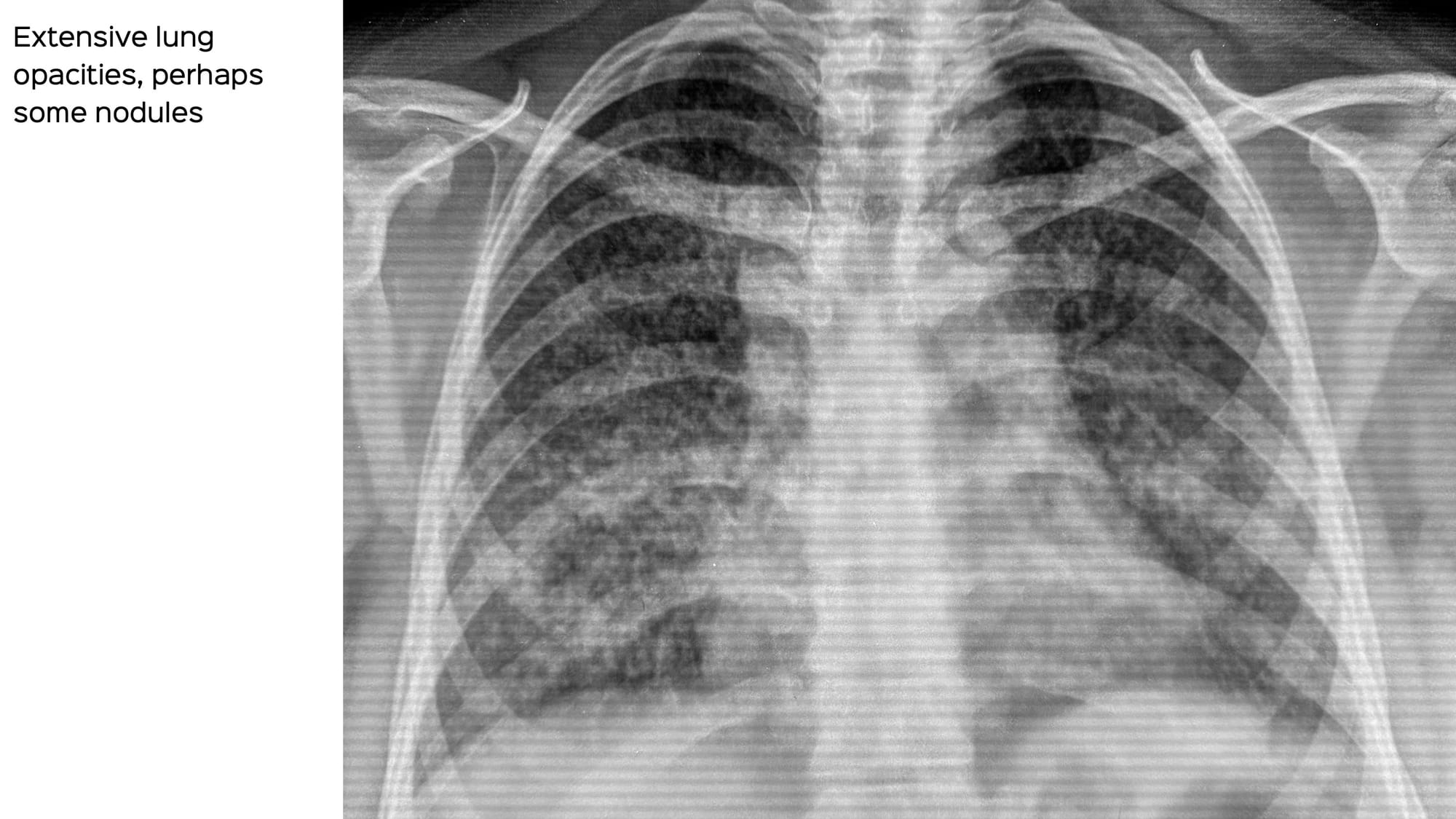 Case 97: How to Identify and Diagnose Miliary TB as a Cause of ARDS