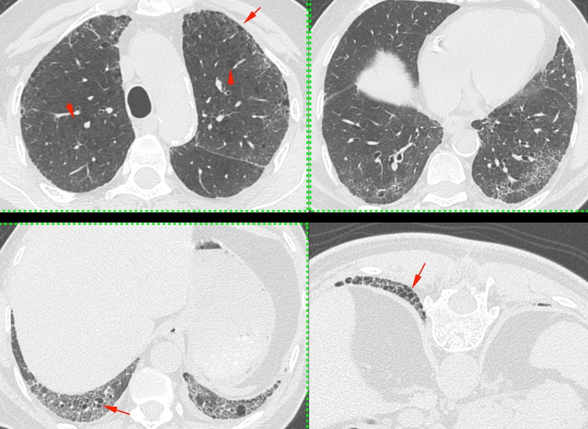 Case 98: Acute Increased Dyspnea in Idiopathic Pulmonary Fibrosis - First Considerations