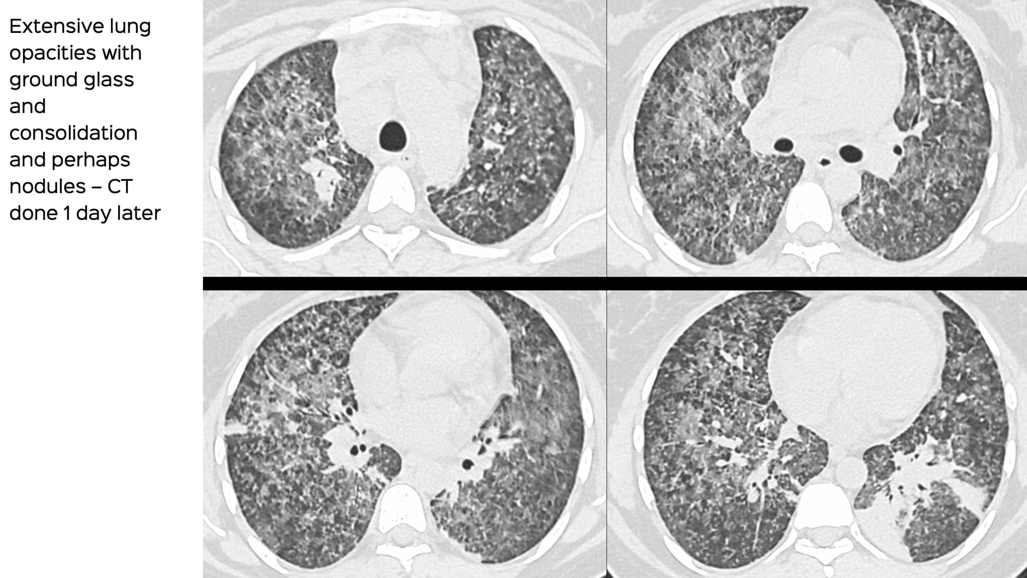Case 97: How to Identify and Diagnose Miliary TB as a Cause of ARDS