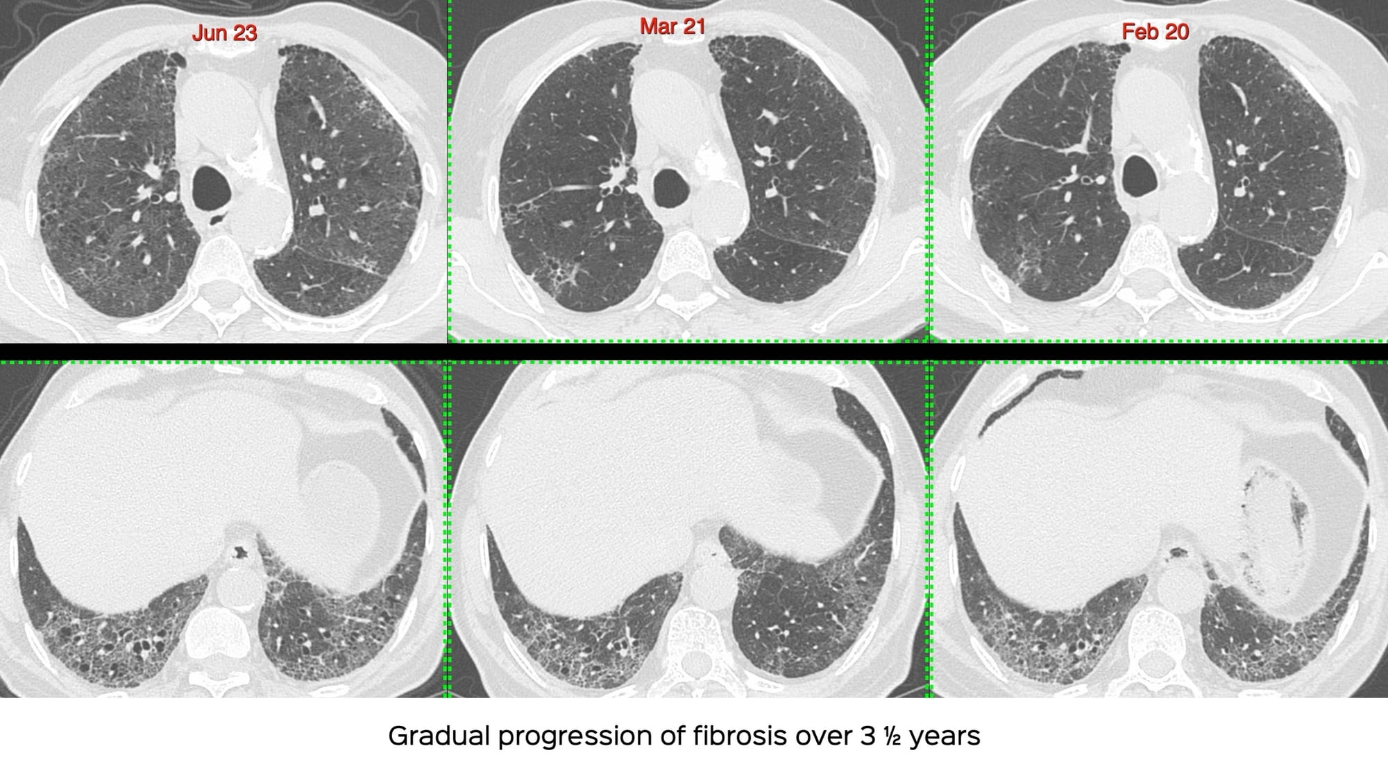 Case 98: Acute Increased Dyspnea in Idiopathic Pulmonary Fibrosis - First Considerations