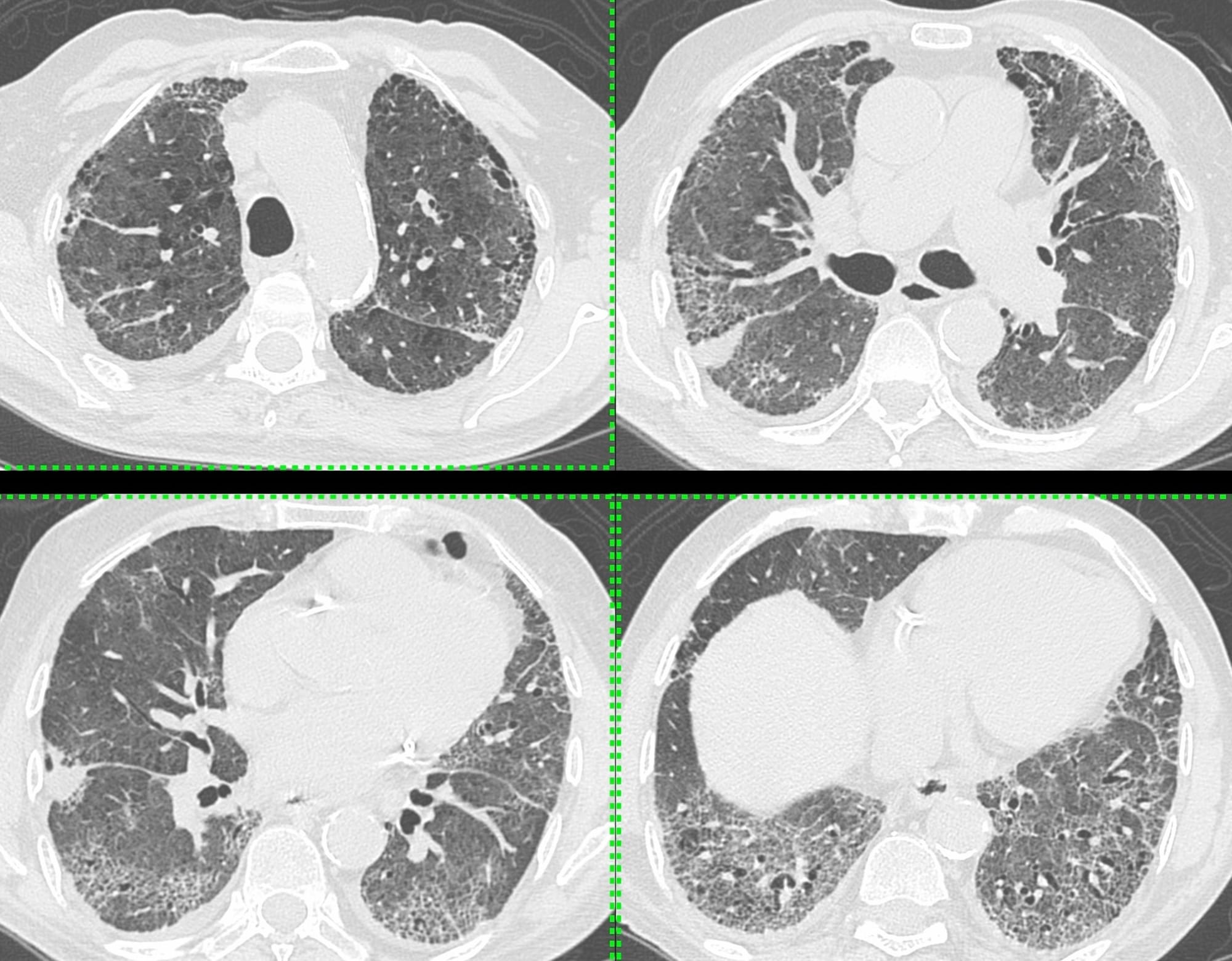 Case 98: Acute Increased Dyspnea in Idiopathic Pulmonary Fibrosis - First Considerations