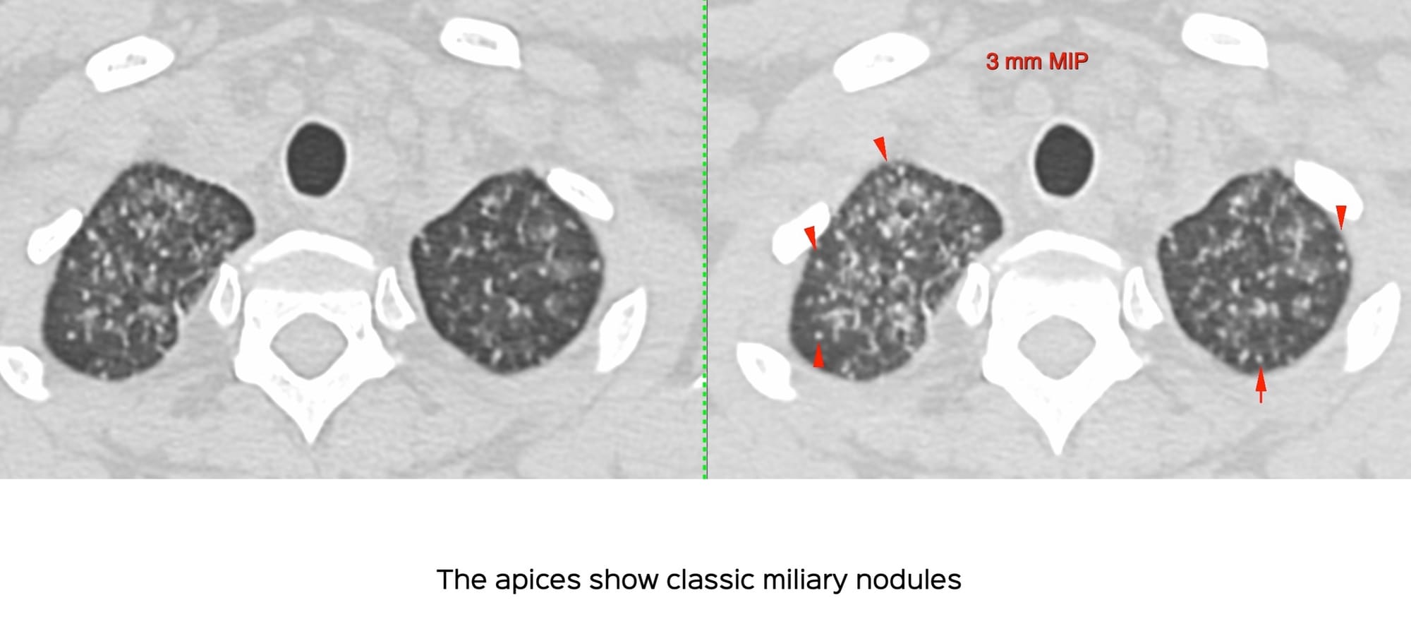 Case 97: How to Identify and Diagnose Miliary TB as a Cause of ARDS