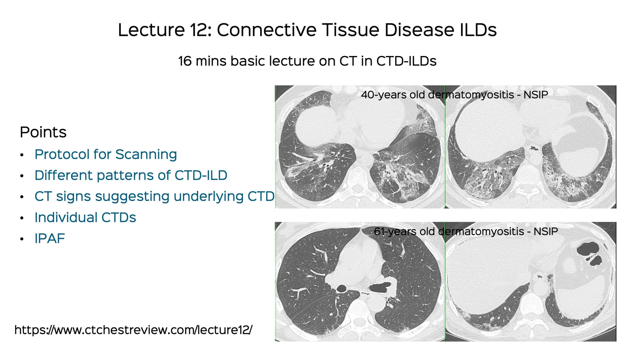 Lecture: Connective Tissue Disease ILDs