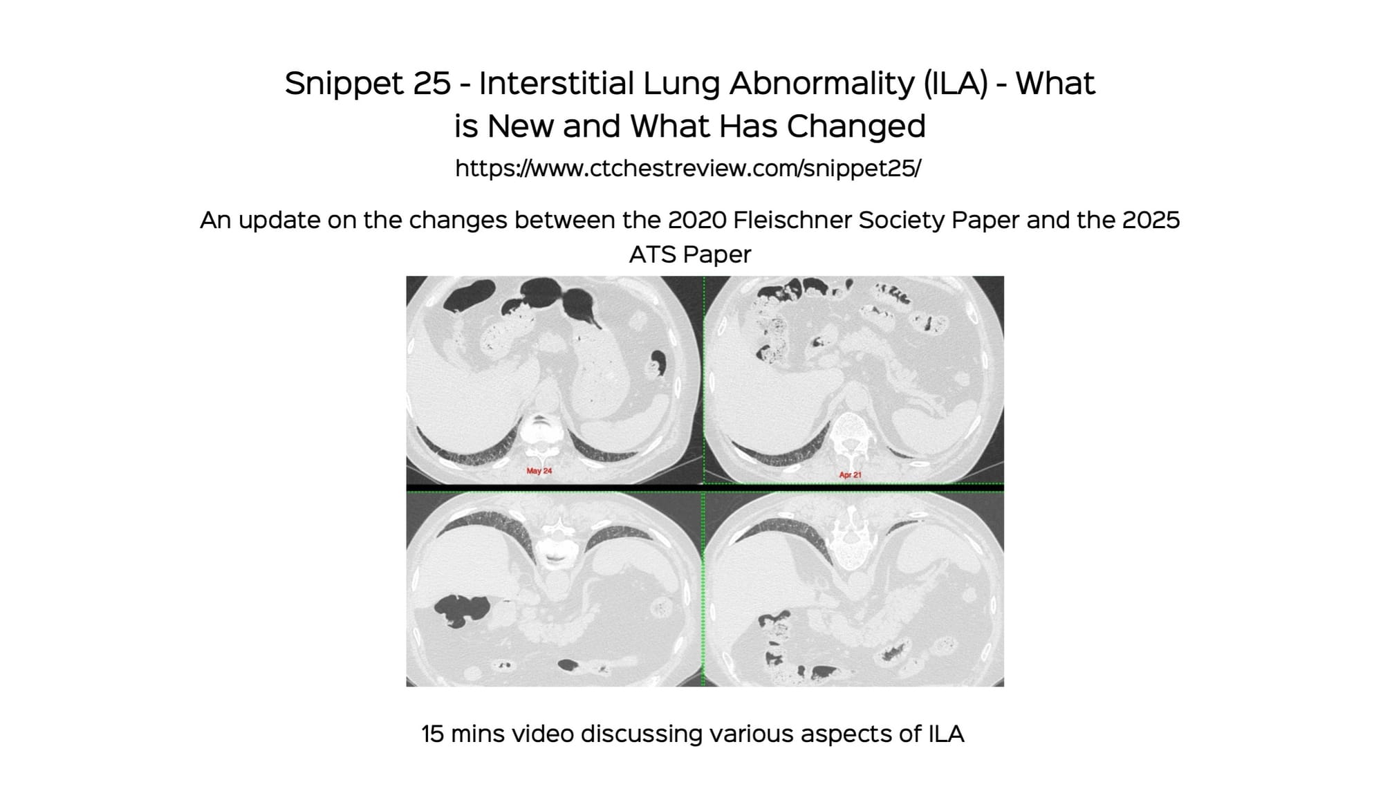 Snippet 25: Interstitial Lung Abnormality (ILA) - What is New and What Has Changed