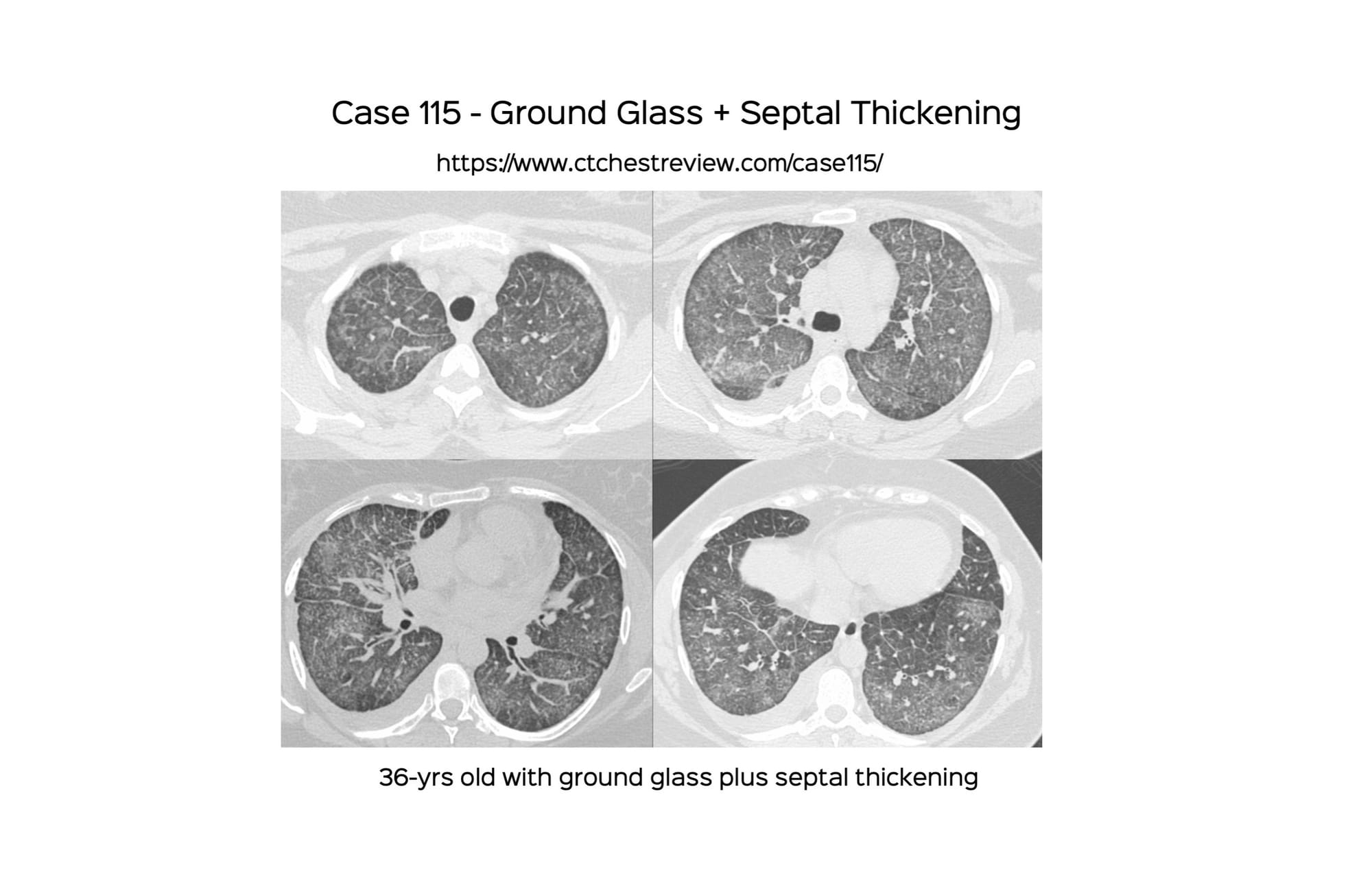 Case 115 - Ground Glass + Septal Thickening