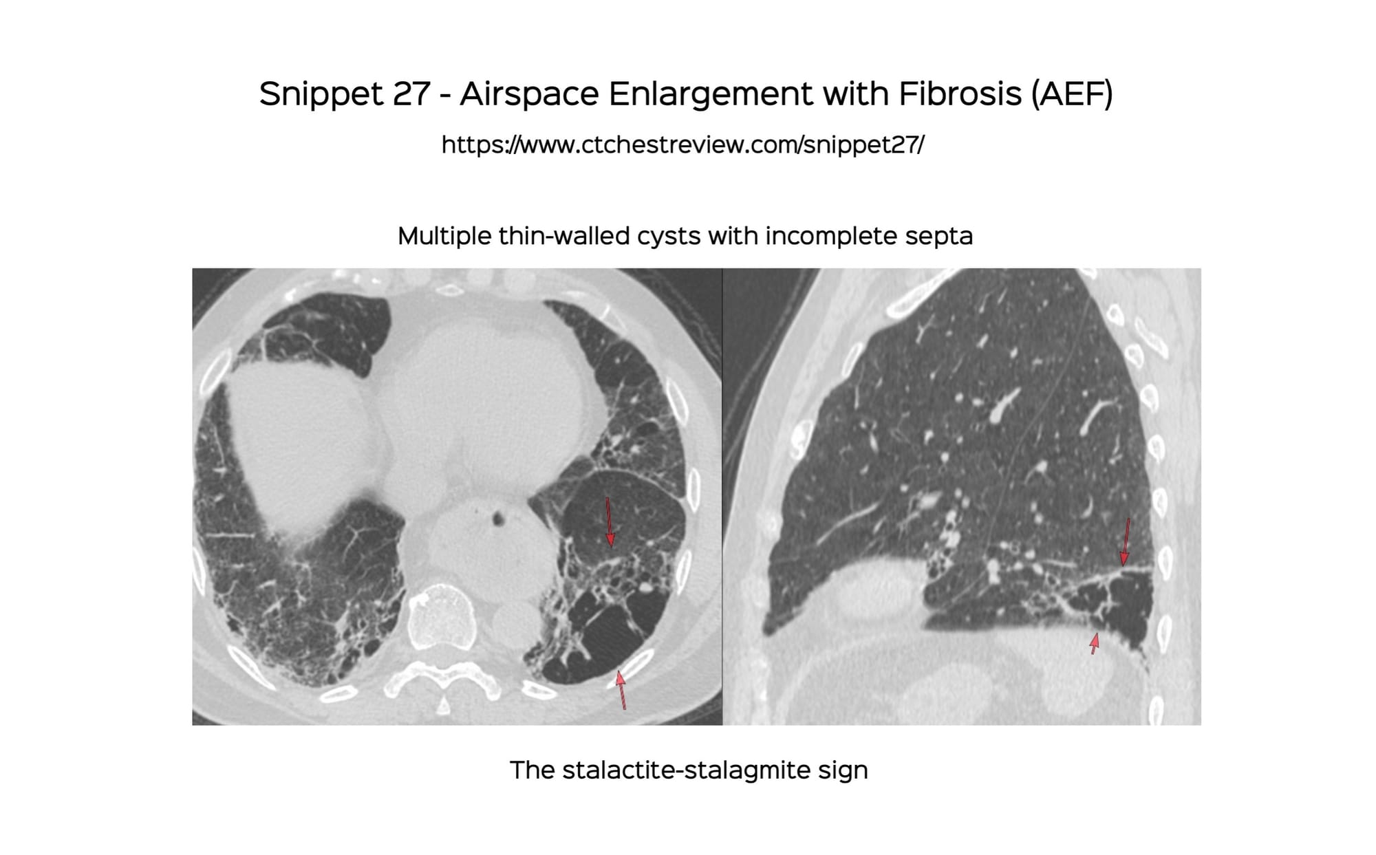 Snippet 27: Airspace Enlargement with Fibrosis (AEF)