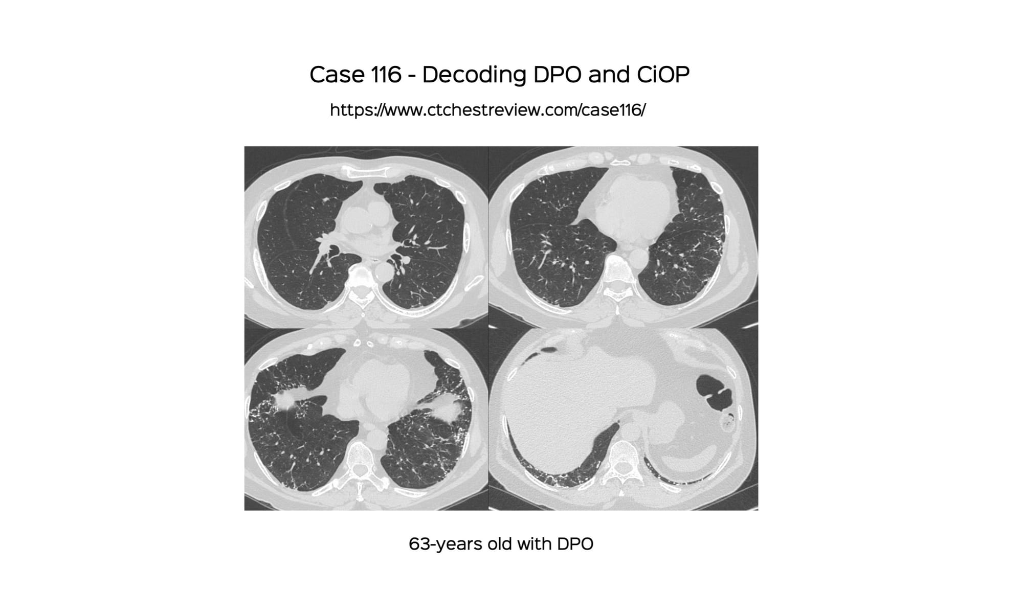 Case 116 - Decoding DPO and CiOP