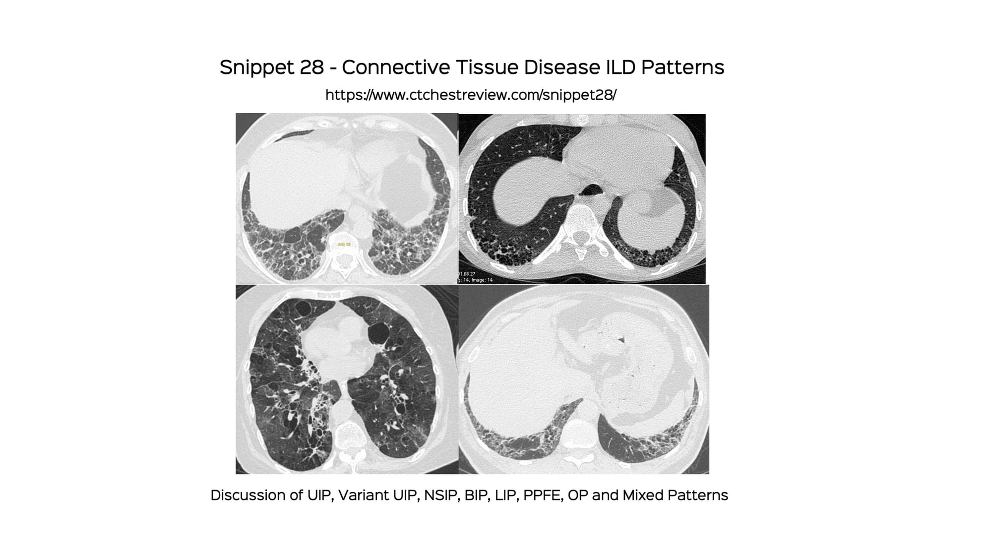 Snippet 28: Connective Tissue Disease ILD Patterns
