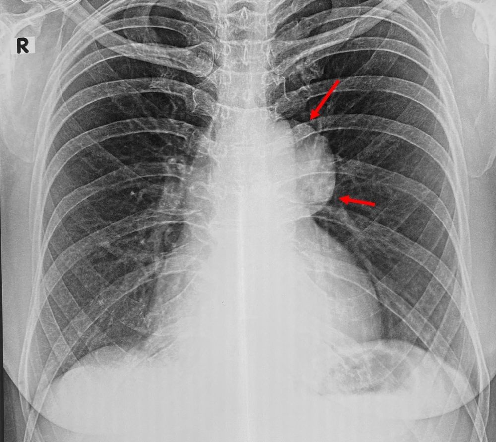 Case 87 Thymic Cyst or Cystic Thymoma