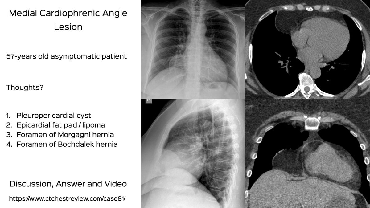 Case 81 Medial Cardiophrenic Angle Lesion case-81-medial-cardiophrenic-angle-lesion