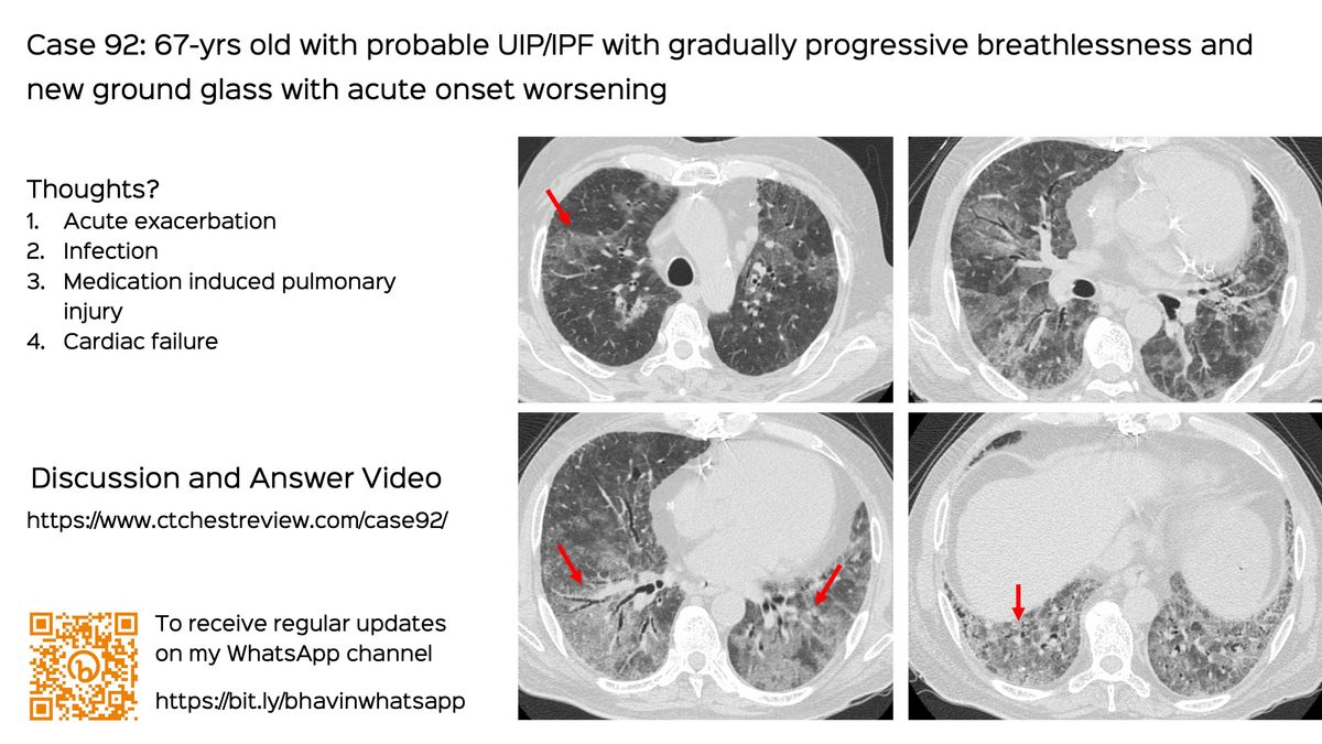 Case 93: The Asymmetric Chest Wall