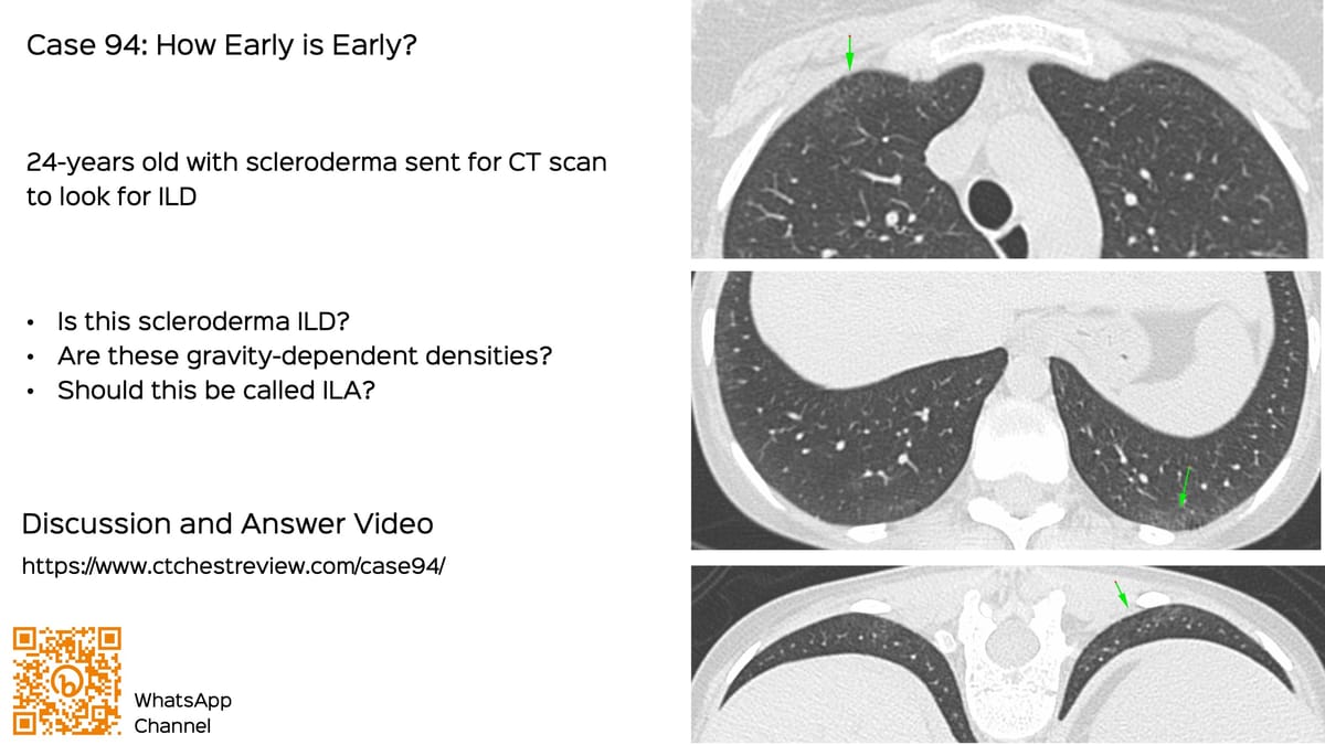 Lecture: CT of Hypersensitivity Pneumonitis