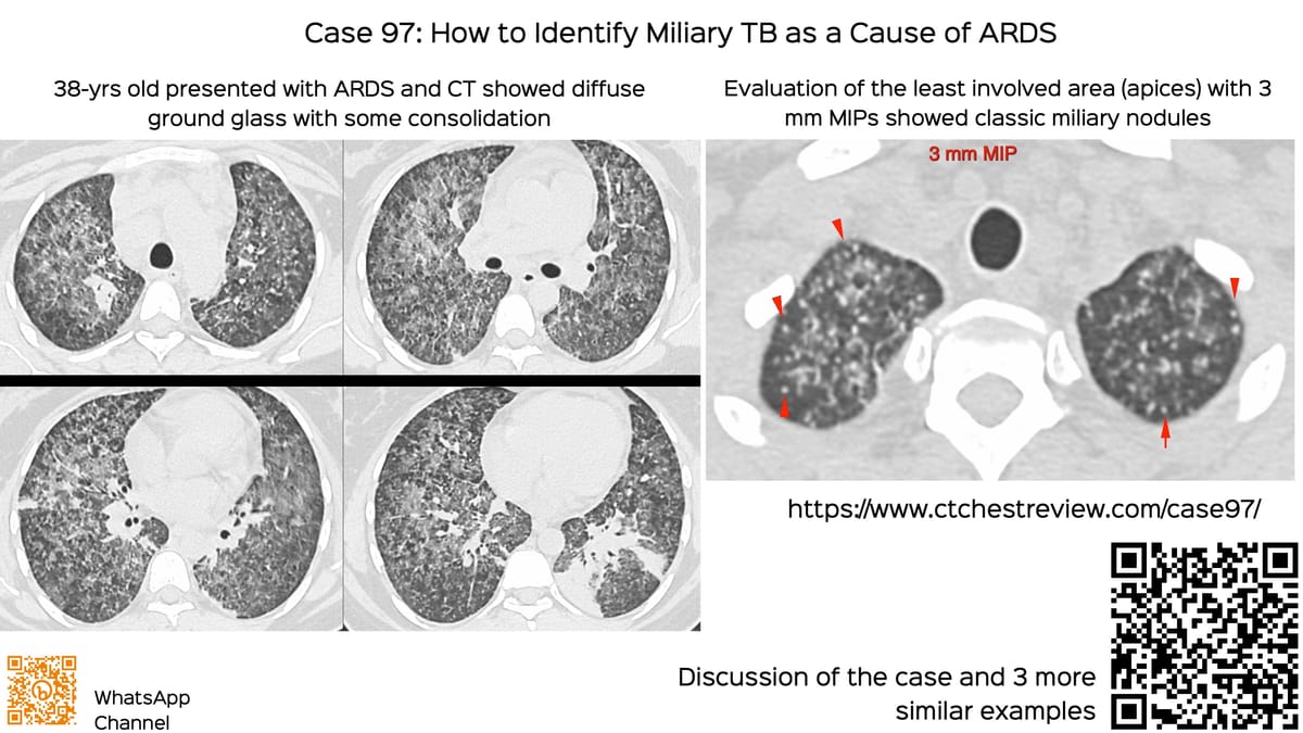 Case 143: Long Parallel Approach to Small Pleural Lesions