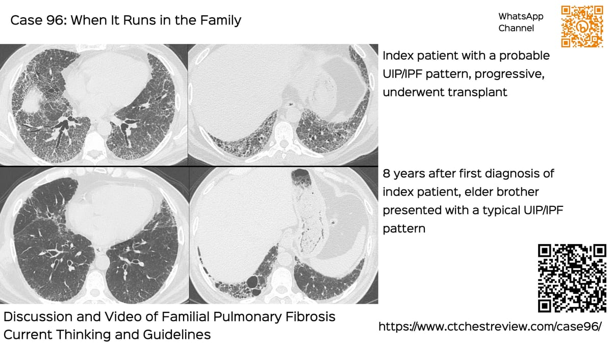 Case 142: Sub 5 mm Lung Nodule Biopsy