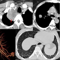 Case 143: Long Parallel Approach to Small Pleural Lesions