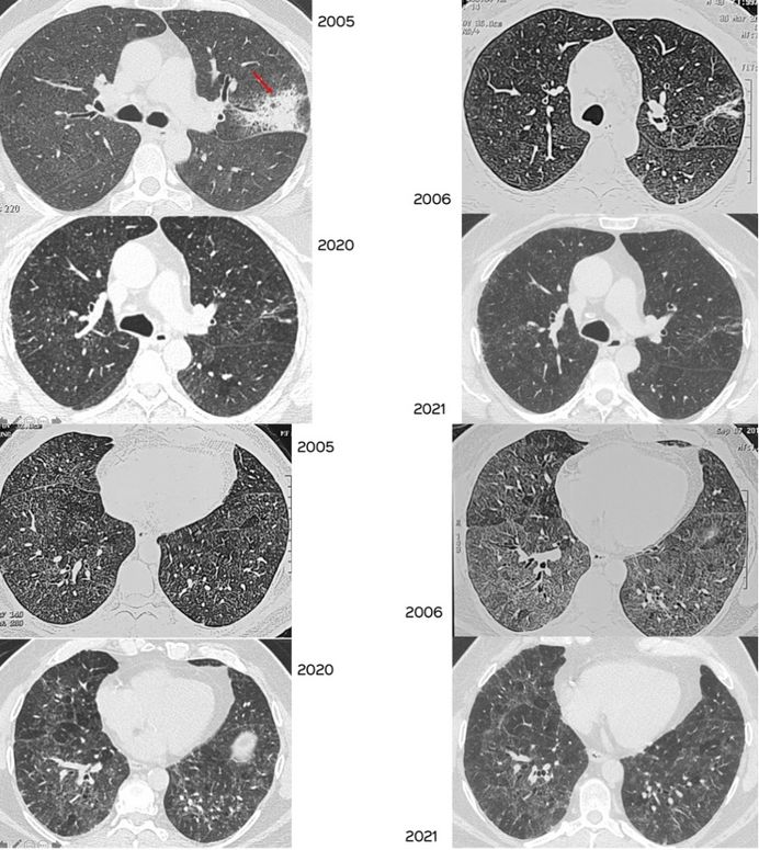 Hypersensitivity Pneumonitis CT Chest Review