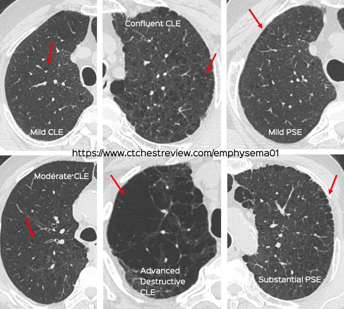 Snippet 12 visual classification of centrilobular and paraseptal emphysema
